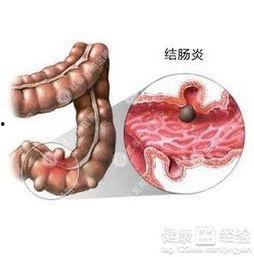 结肠炎患者可以吃鲜瓜吗,鲜瓜的适宜与禁忌